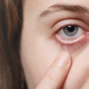 Blepharitis